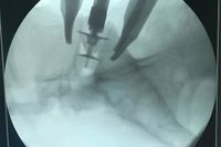 В Волгограде изобрели новую методику лечения позвоночника