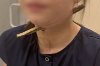 Настоящее чудо: в Ростове ветка «прошила» насквозь шею девочки, ее спасли