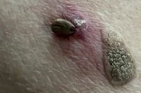 Волгоградка испугалась рака из-за клеща на спине