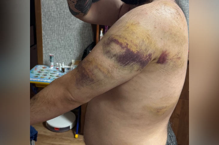 «Челюсть сломана, тело — сплошной синяк»: толпа подростков зверски избила волгоградца на «Юбилейном»