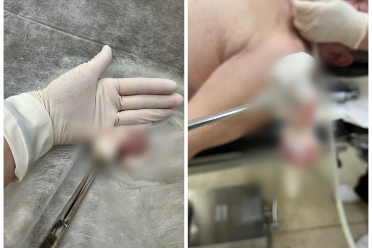 Врачи спасли саратовца с огромным куском сала в горле