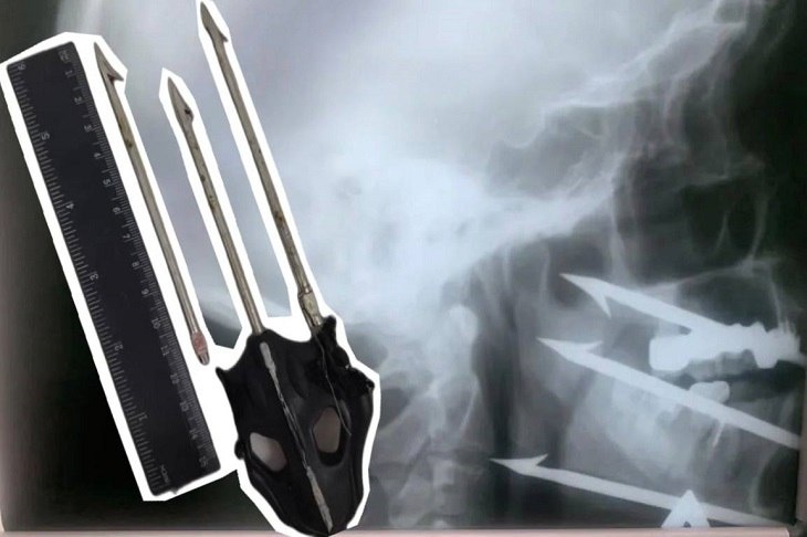 Врачи спасли волгоградца с застрявшим в лице гарпуном